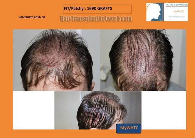 Hair transplantation surgery before and after pictures