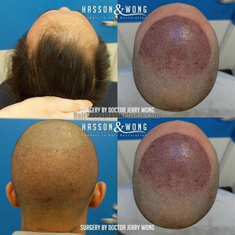 Surgical hair transplantation result photographs