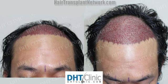 Surgical hair transplantation result photographs