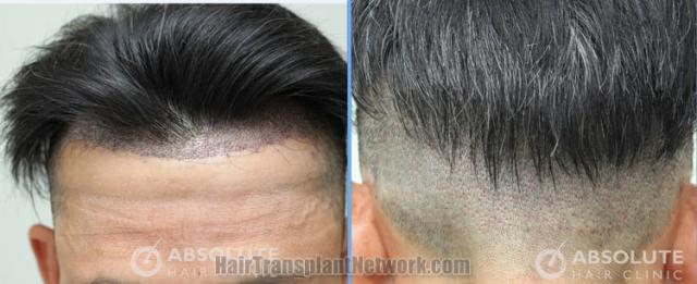 Surgical hair transplantation result photographs