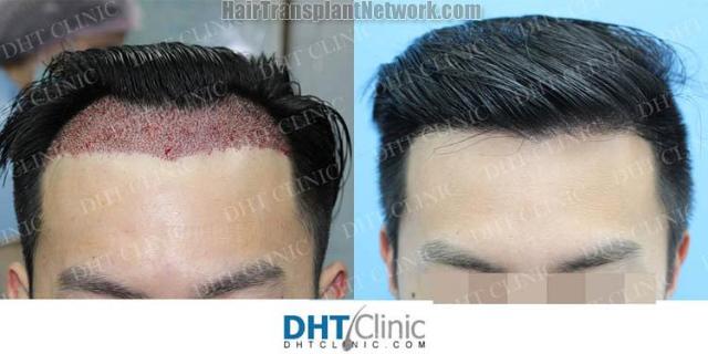 Hair transplantation surgery before and after pictures