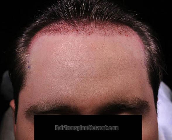 Hair transplantation surgery before and after photos