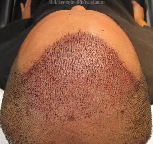 Hair restoration surgery before and after photos