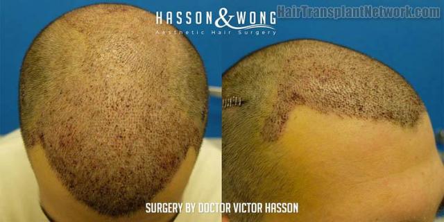 Hair transplant surgery before and after images