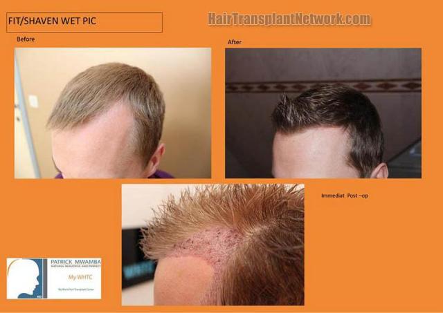 Hair transplantation surgery before and after photos