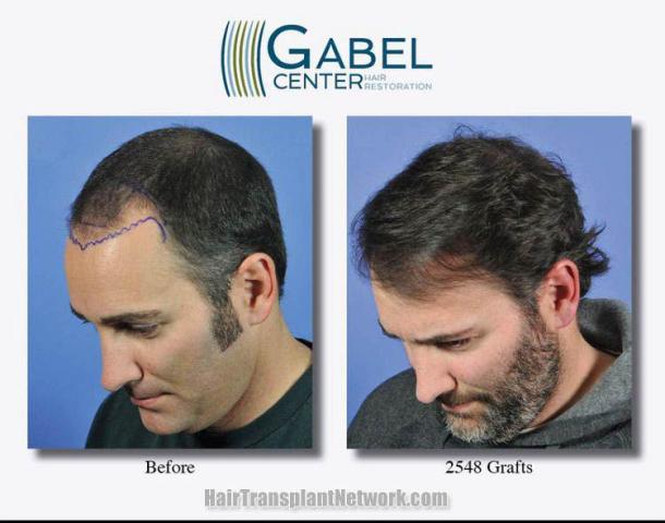 Hair transplant surgery before and after photos