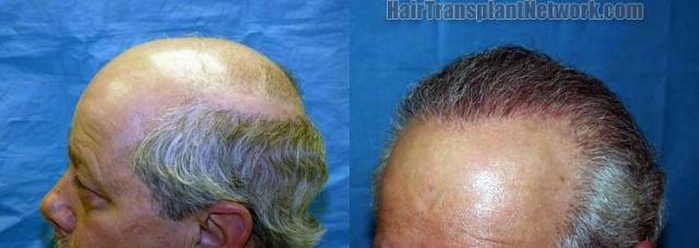 Left view before and after hair restoration procedure