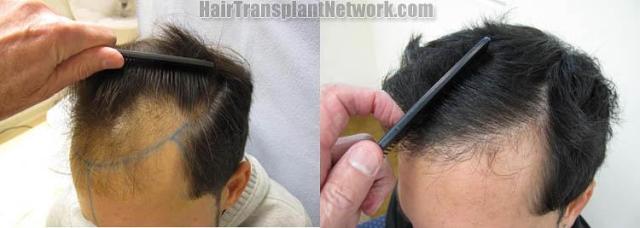 Surgical hair transplantation result photographs