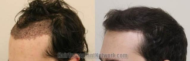 Hair restoration procedure before and after pictures