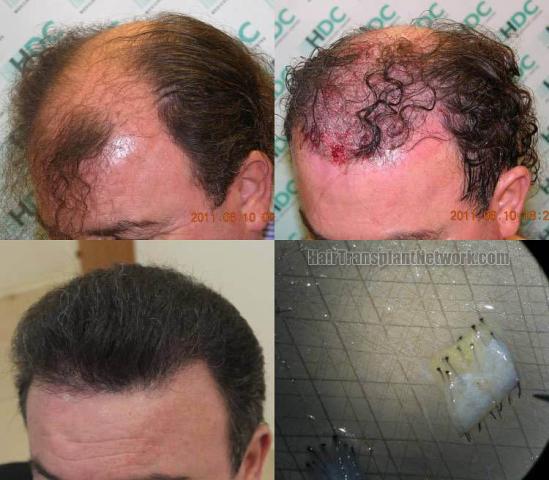 Hair transplantation surgery before and after photos