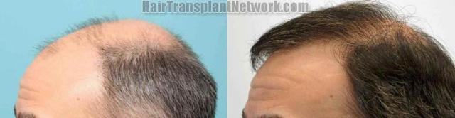 Hair restoration procedure before and after results