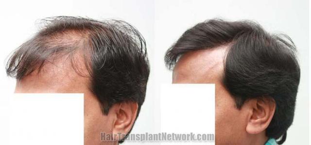 Hair transplantation surgery before and after photos