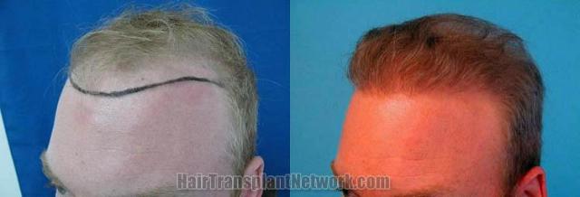 Hair restoration procedure before and after results