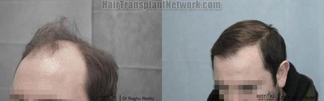 Hair transplantation surgery before and after photos