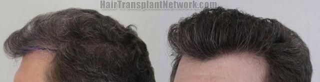 Hair transplantation surgery before and after pictures