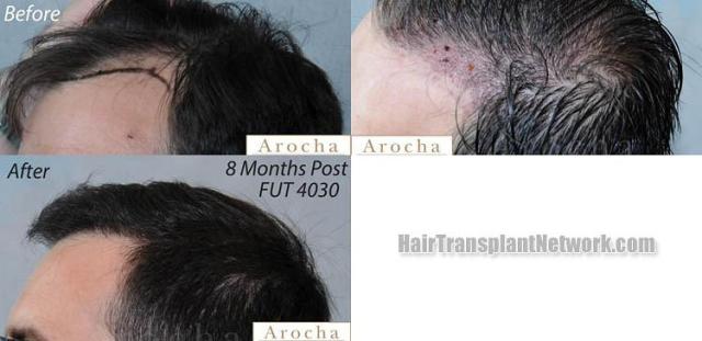 Hair transplantation surgery before and after images