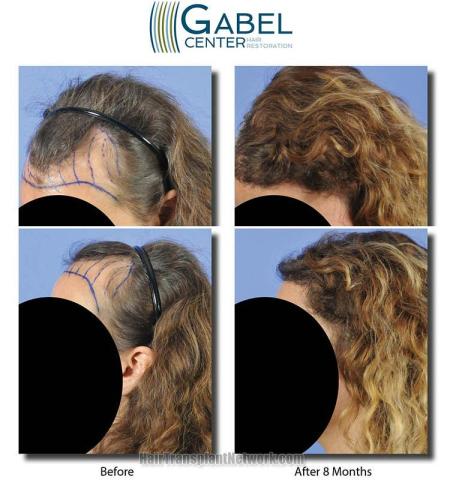 Hair transplantation surgery before and after photos