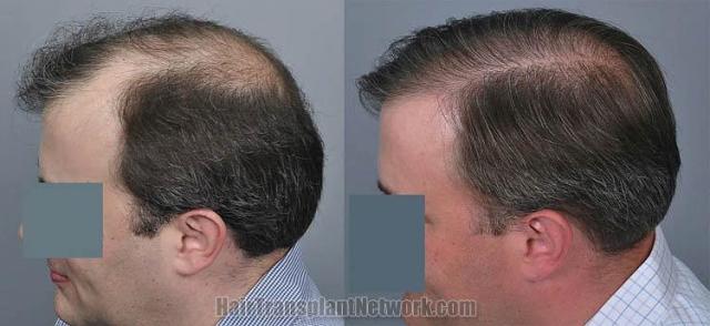 Hair transplantation surgery before and after pictures