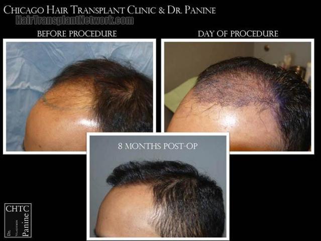 Hair transplantation surgery before and after images