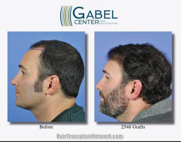 Hair transplantation surgery before and after pictures