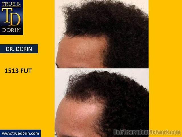 Hair transplantation surgery before and after photos