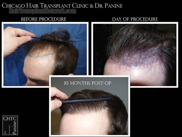 Hair transplantation surgery before and after pictures