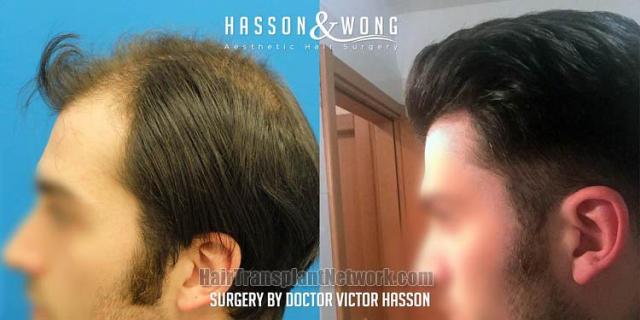 Hair restoration procedure before and after pictures