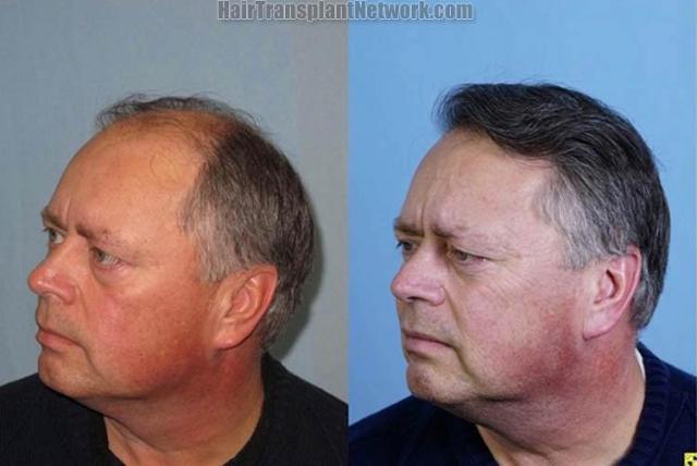 Hair transplantation surgery before and after photos