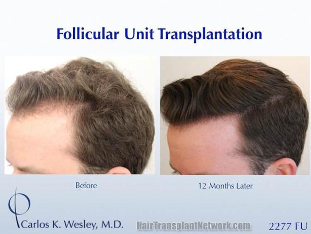 Hair transplantation surgery before and after photos