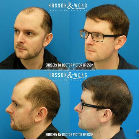 Hair transplantation surgery before and after photos