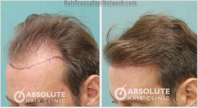 Hair restoration procedure before and after pictures