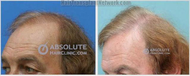 Hair restoration procedure before and after pictures