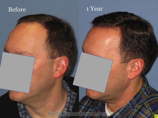 Hair transplantation surgery before and after pictures