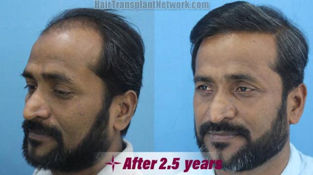 Hair restoration procedure results