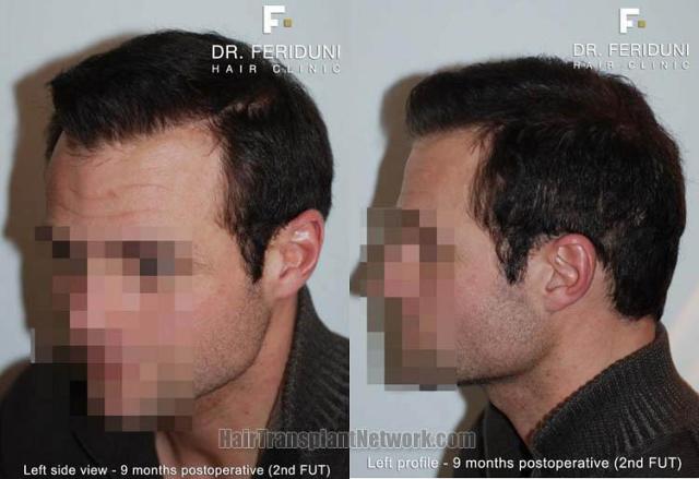 Hair transplant surgery before and after photos