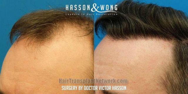 Surgical hair transplantation result photographs