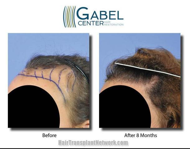 Hair transplant surgery before and after photos