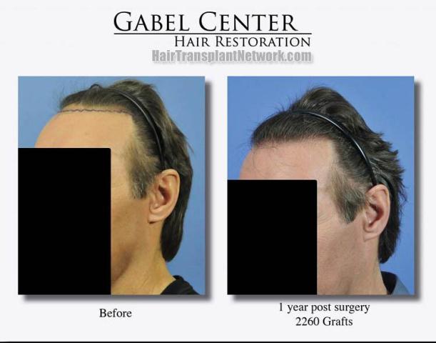 Hair restoration procedure before and after pictures