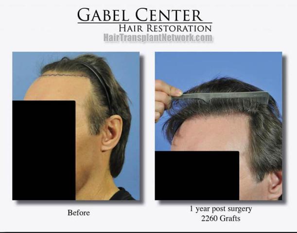 Hair restoration surgery before and after images