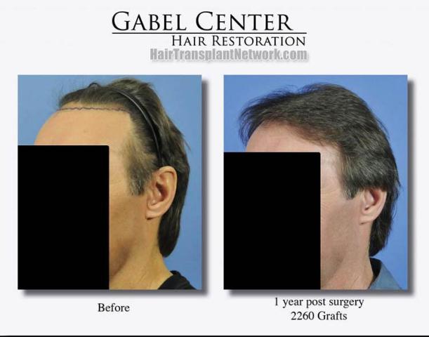 Hair transplant surgery before and after images