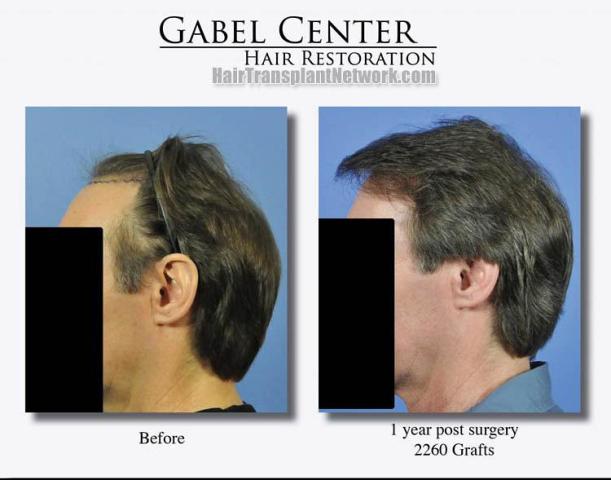 Hair transplantation surgery before and after images