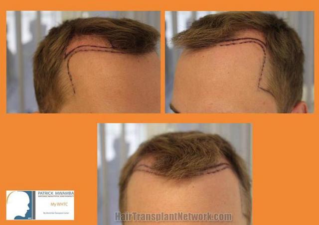 Hair transplantation surgery before and after images