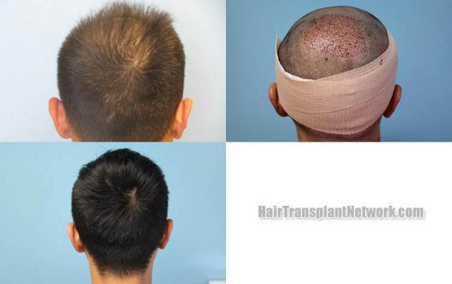 Hair transplantation surgery before and after images