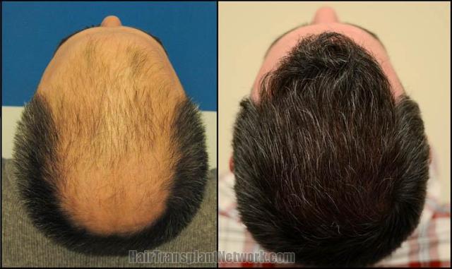 Hair restoration surgery before and after images