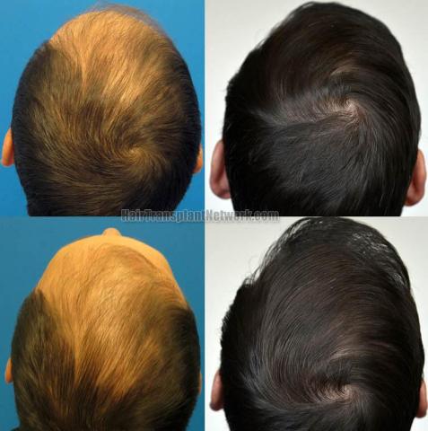 Hair restoration procedure before and after pictures