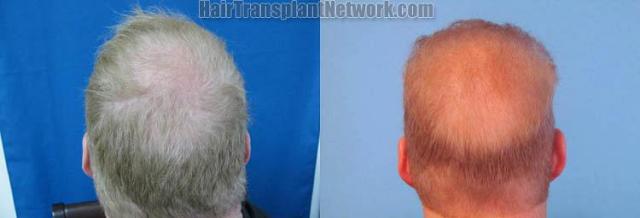 Hair transplantation surgery before and after images