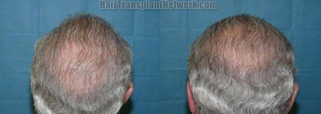 Back view after hair transplantation photographs