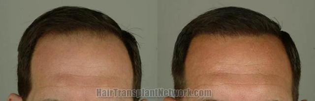 Hair transplantation surgery before and after photos