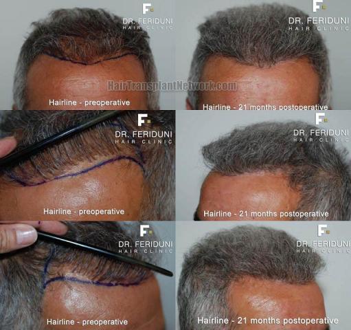 Hair restoration surgery before and after photos