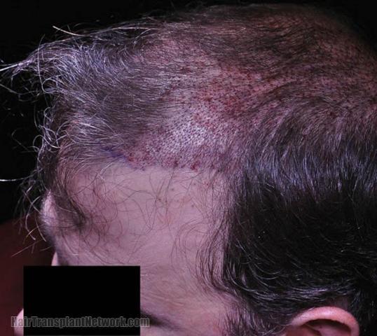 Hair restoration procedure before and after pictures